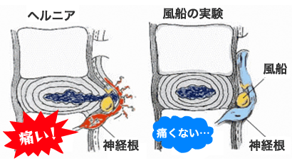 椎間板ヘルニア風船実験のイラスト