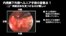 MED手術動画