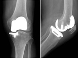 人工膝関節二顆置換術のインプラント