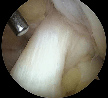 正常な膝前十字靭帯の内視鏡画像