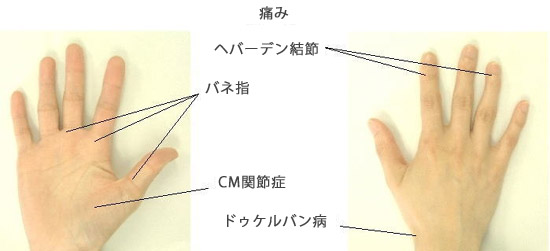 親指 の 付け根 が 痛い