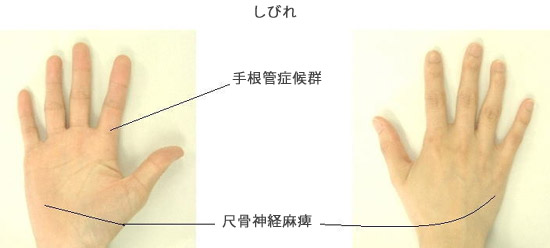 肘と手の障害 手根管症候群 整形外科 岩井グループ