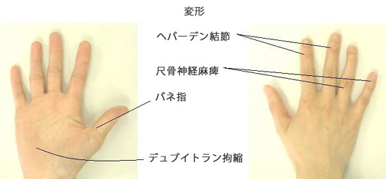 肘と手の障害 手根管症候群 整形外科 岩井グループ