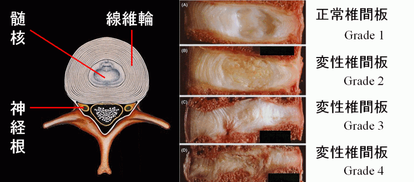 腰椎椎間板変性症で線維輪が変形した図