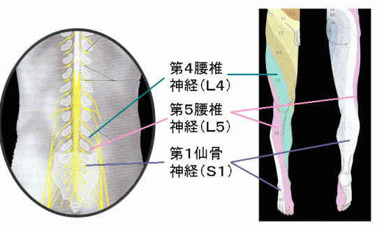 腰のL4、L5、S1の神経と下肢の痛み部分を示した図、いわゆるデルマトームというものです