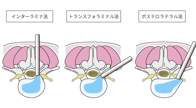 3種類のアプローチ方法