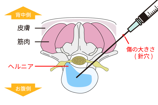 ヘルニコア