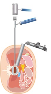 スクリューの挿入