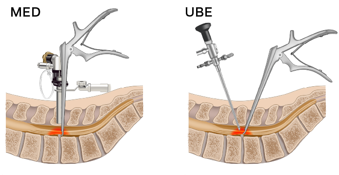 UBE:腰部脊柱管狭窄症の内視鏡下手術|稲波脊椎・関節病院 UBE:腰部脊柱管狭窄症の内視鏡下手術|稲波脊椎・関節病院