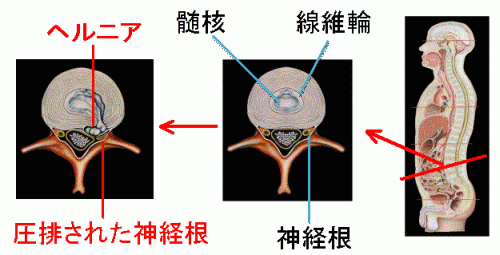 椎間板の構造とヘルニアにより圧迫された神経根の図