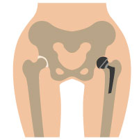 股関節の手術