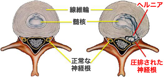 椎間板の断面図