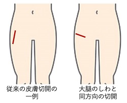 人工股関節置換術の皮膚切開イメージ