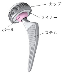 人工股関節インプラント