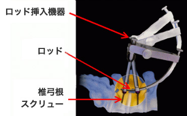 ME-PLIF法 ロッド挿入イメージ