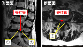 腰部脊柱管狭窄症のMRI画像