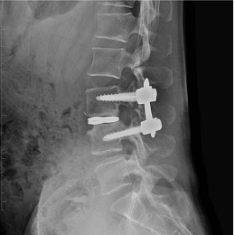 OLIF手術イメージ