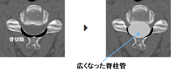 椎弓切除法のイメージ