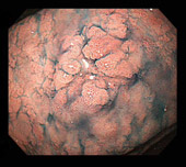 早期胃がんの画像