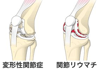 変形性関節症と関節リウマチの画像