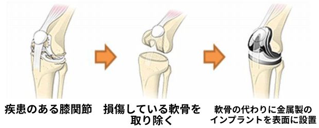 人工膝関節手術の流れ図