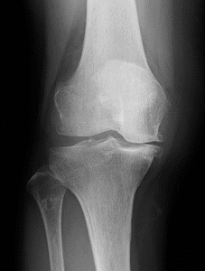 変形性膝関節症の人工関節置換手術前の正面X線写