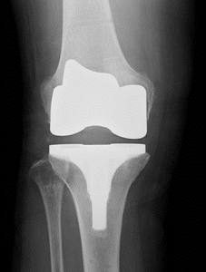 変形性膝関節症の人工関節置換手術後の正面X線写真