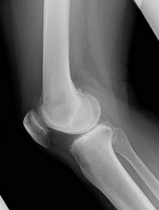 変形性膝関節症の人工関節置換手術前の側面X線写真