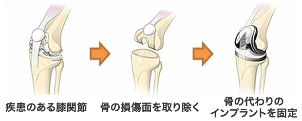 人工膝関節手術の流れ図