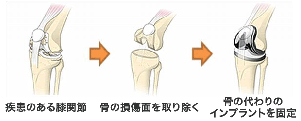 膝 の 手術 の 名医