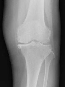 変形性膝関節症の人工関節置換手術前の正面X線写