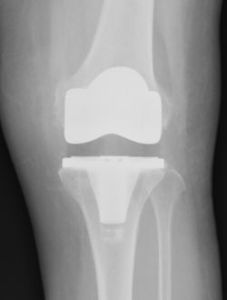 変形性膝関節症の人工関節置換手術後の正面X線写真