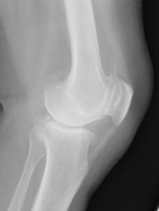 変形性膝関節症の人工関節置換手術前の側面X線写真