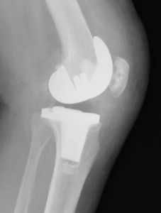 変形性膝関節症の人工関節置換手術後の側面X線写真