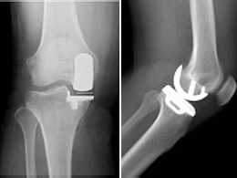 人工膝関節単顆置換術のインプラント
