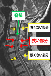 頚椎ヘルニア 頚部脊柱管狭窄症の手術について 岩井整形外科内科病院