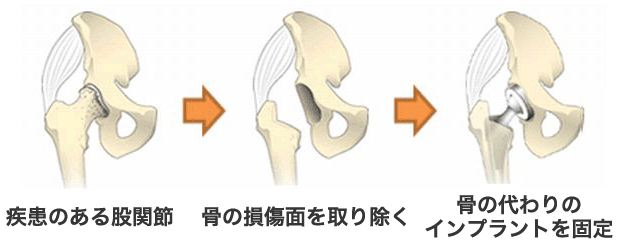 人工股関節置換術の流れ図