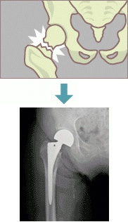 大腿骨頚部骨折のイラストとX線写真