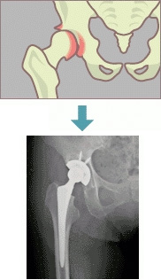 変形性股関節症のイラストとX線写真