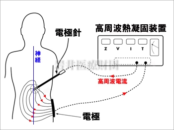 高周波熱凝固装置による熱凝固法