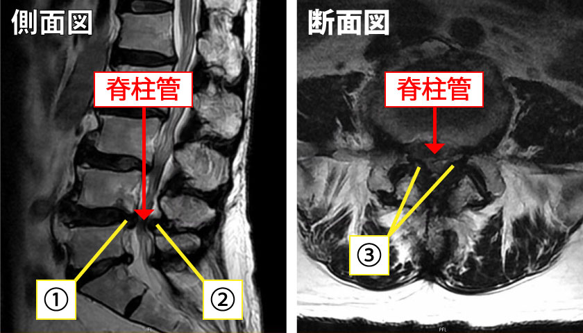 腰部脊柱管狭窄症の手術について 岩井整形外科内科病院