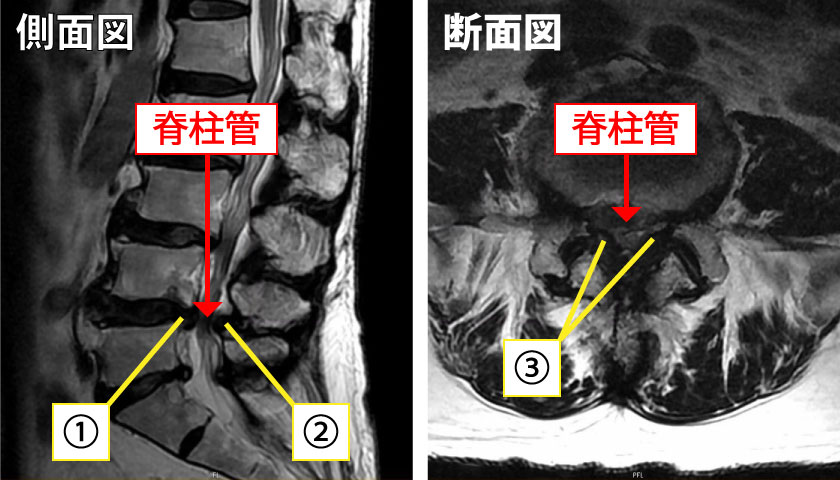 脊柱 管 狭窄 症 治っ た