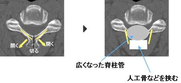 頚椎椎弓形成術：頚部脊柱管狭窄症の内視鏡下手術｜岩井整形外科病院