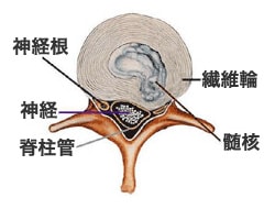 椎間板ヘルニアのイラスト
