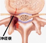 神経根型のイラスト