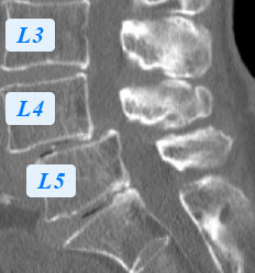 腰椎すべり症 CT側面像