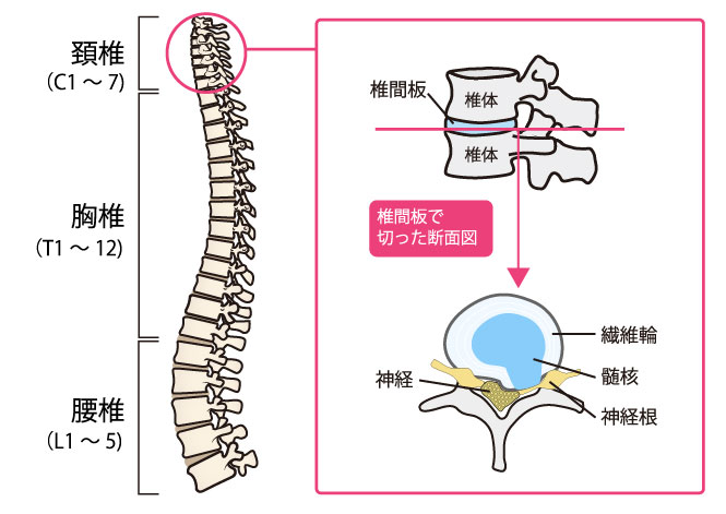 ヘルニア 治る のか