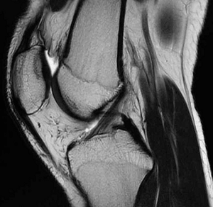 正常な膝前十字靭帯のMRI画像