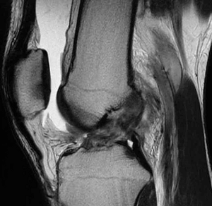 膝前十字靭帯が損傷しているMRI画像