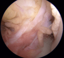 膝前十字靭帯が損傷している内視鏡画像